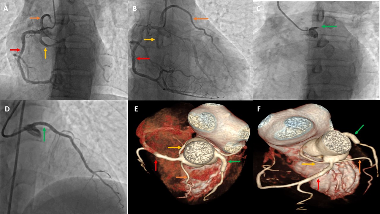 Coronary Angiography